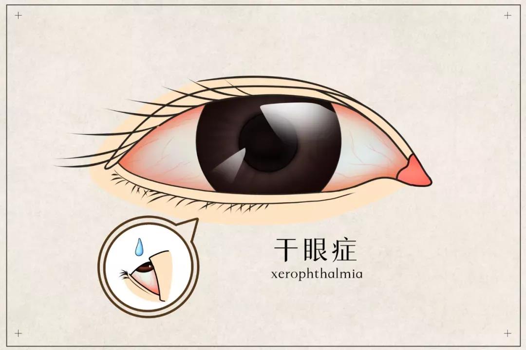干眼患者福音來(lái)啦！(圖2)